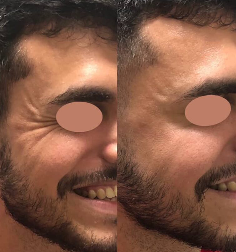 Resultado real de botox na Benvida